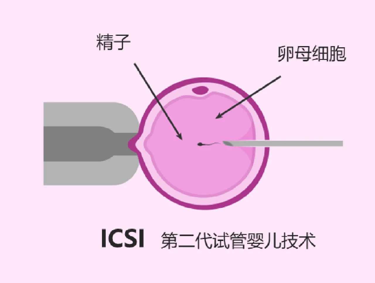 借卵试管婴儿河北省_专业不孕不育代孕,试管婴儿的流